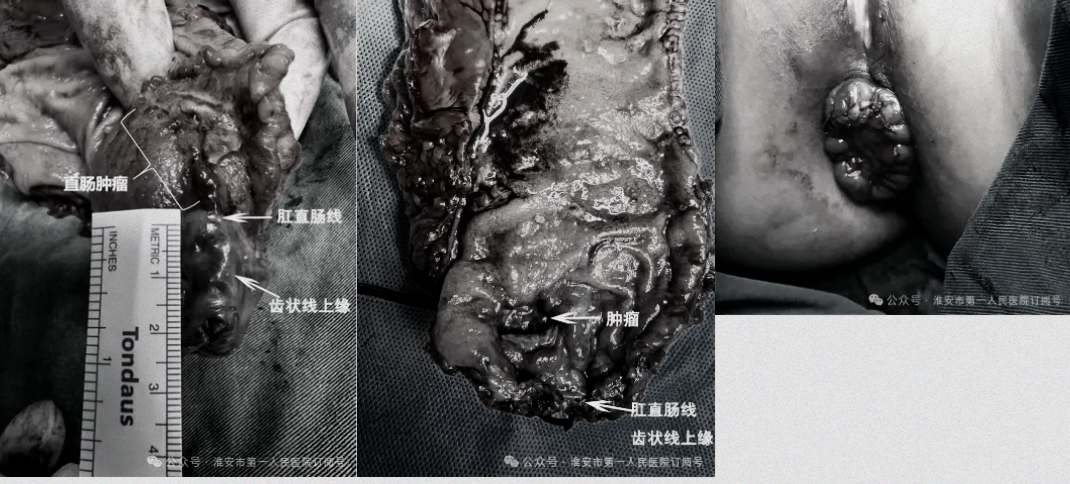 从「大刀阔斧」到「毫厘之争」——淮安市第一人民医院连续开展超低位直肠癌「零距离」保肛手术