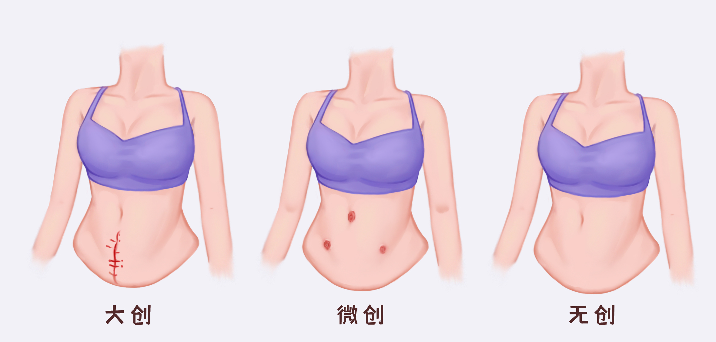 妇科第一瘤，到底留不留？