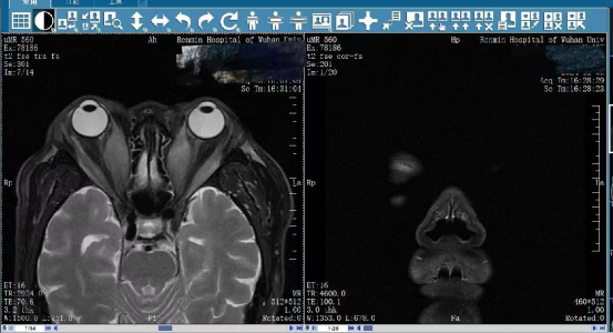 武汉大学人民医院专家为极度凶险甲状腺视神经病变患者「夺回」光明