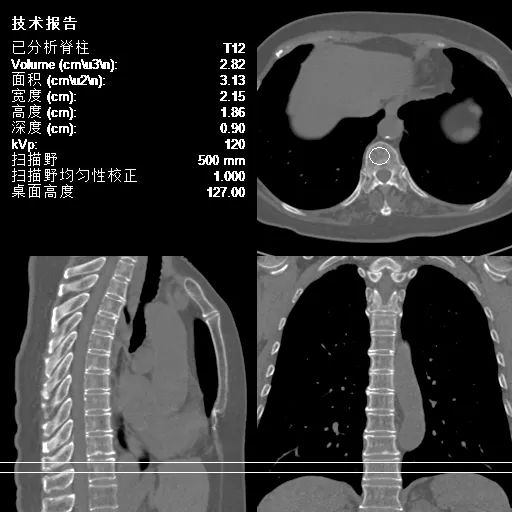骨质疏松筛查新利器——QCT 上线！