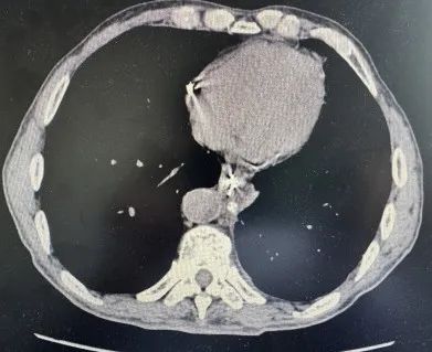 七旬老人食管破裂危及生命！山一大二附院胸外科紧急手术解危机