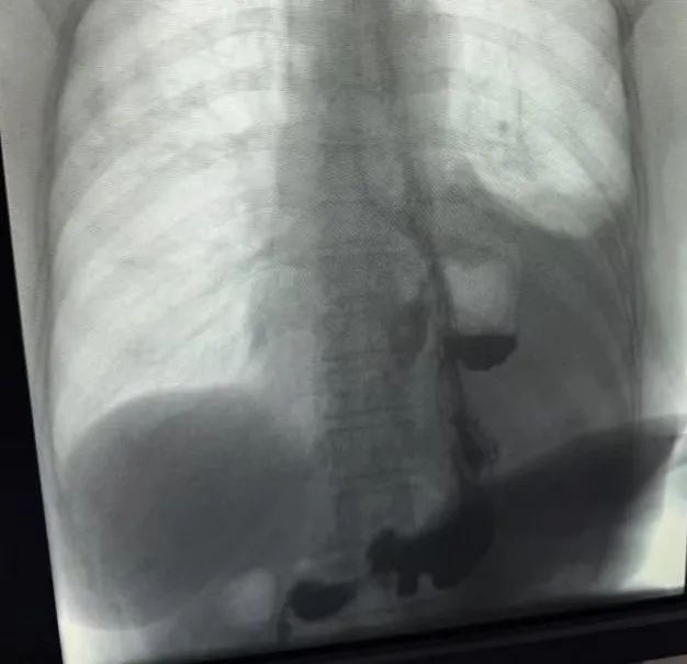 七旬老人食管破裂危及生命！山一大二附院胸外科紧急手术解危机