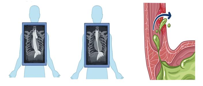 七旬老人食管破裂危及生命！山一大二附院胸外科紧急手术解危机