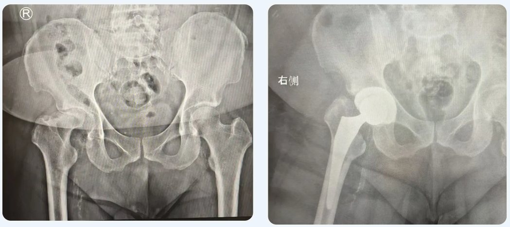 腿痛多年夜不能寐，深圳新风和睦家骨科开展人工髋关节置换术帮助患者顺利康复