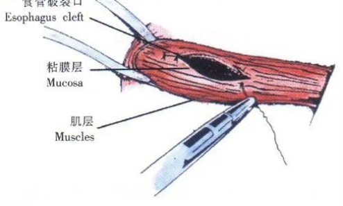七旬老人食管破裂危及生命！山一大二附院胸外科紧急手术解危机