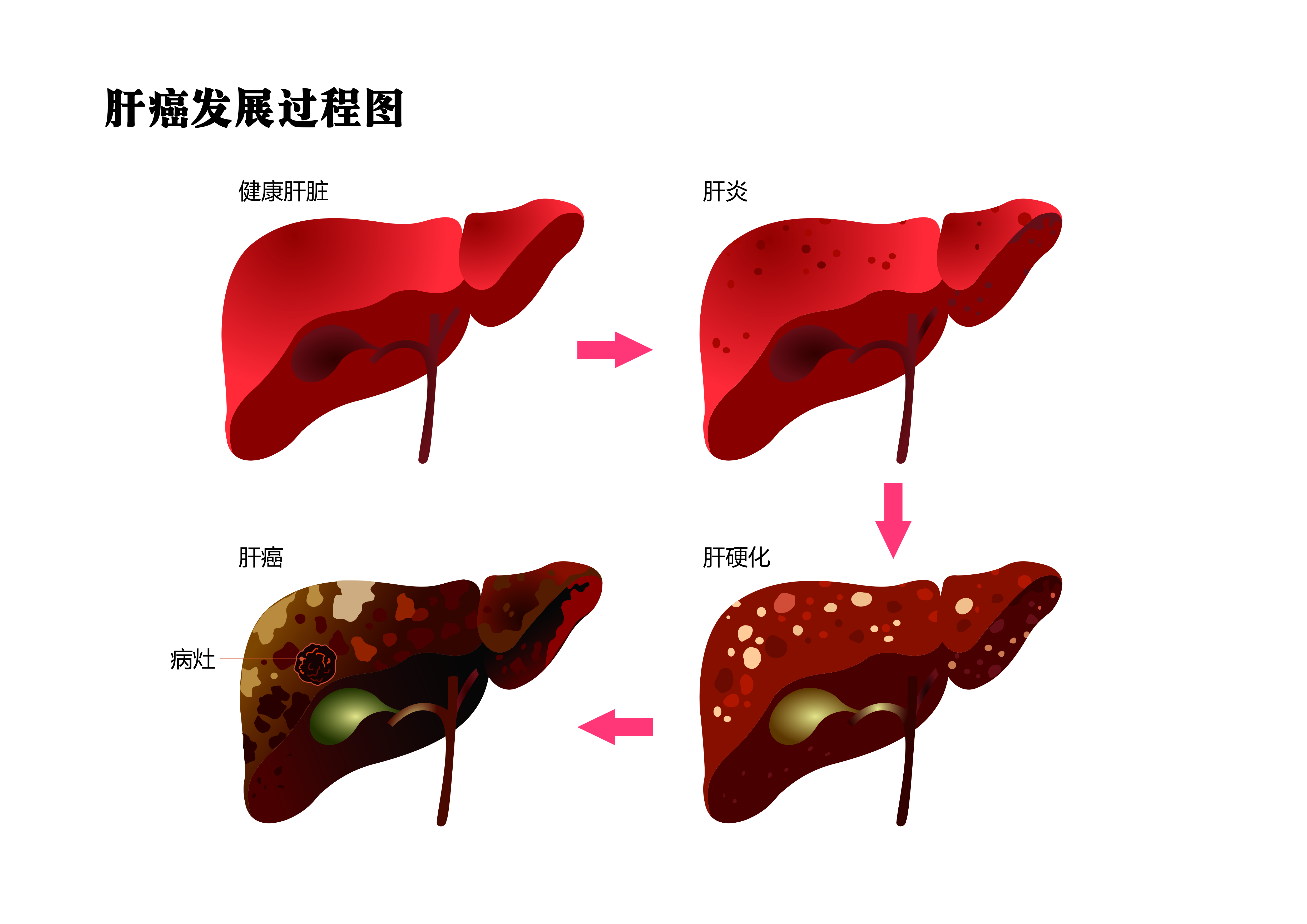 全国肿瘤防治宣传周 | 肝癌可怕，但可防可治