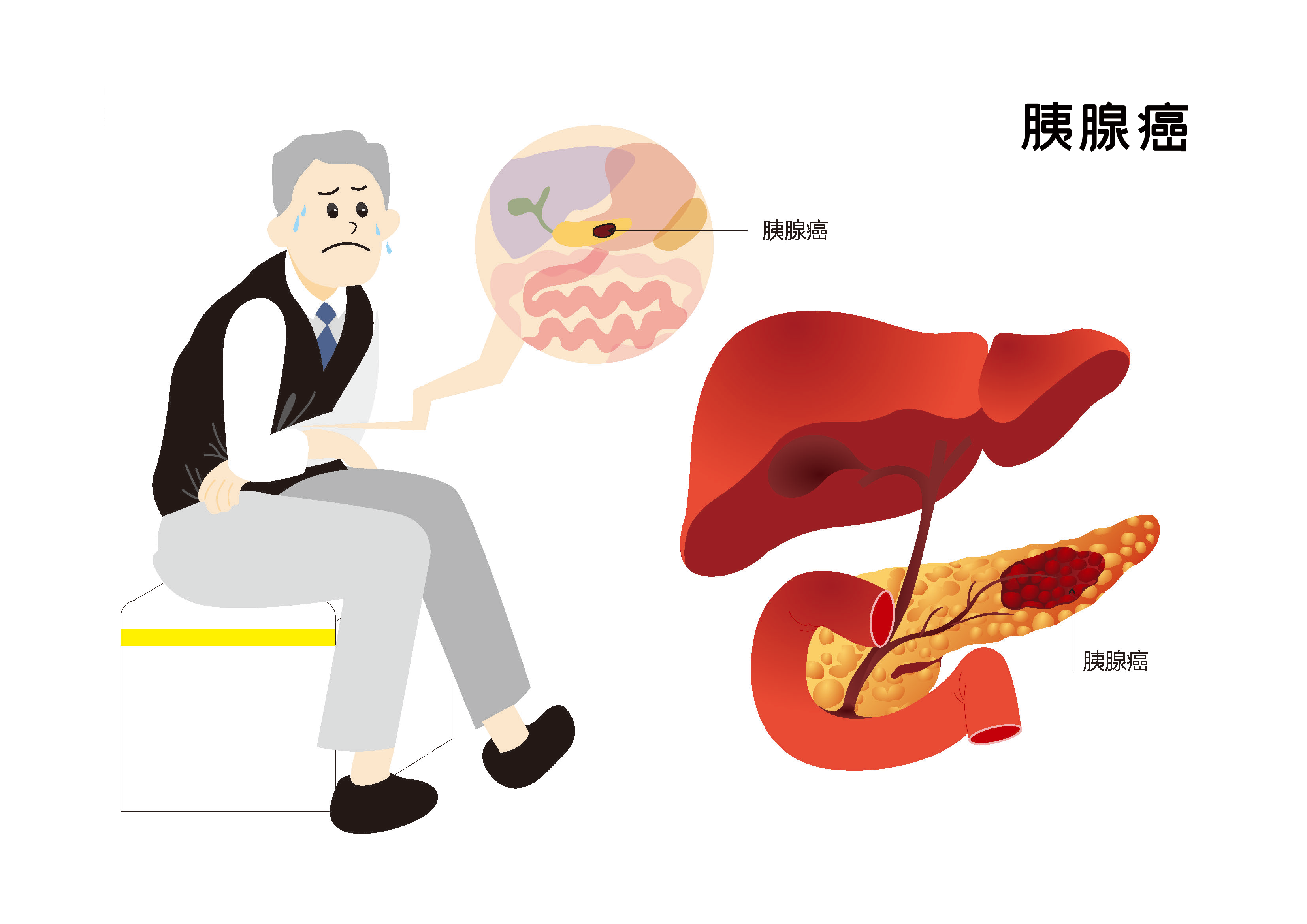 全国肿瘤防治宣传周 |「癌中之王」胰腺癌，你了解多少?