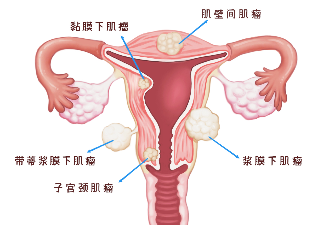 哪些情况下子宫肌瘤容易复发？