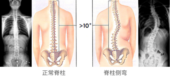 你的脊柱悄悄弯成「贪吃蛇」?速测气质杀手「S 弯超标没」!