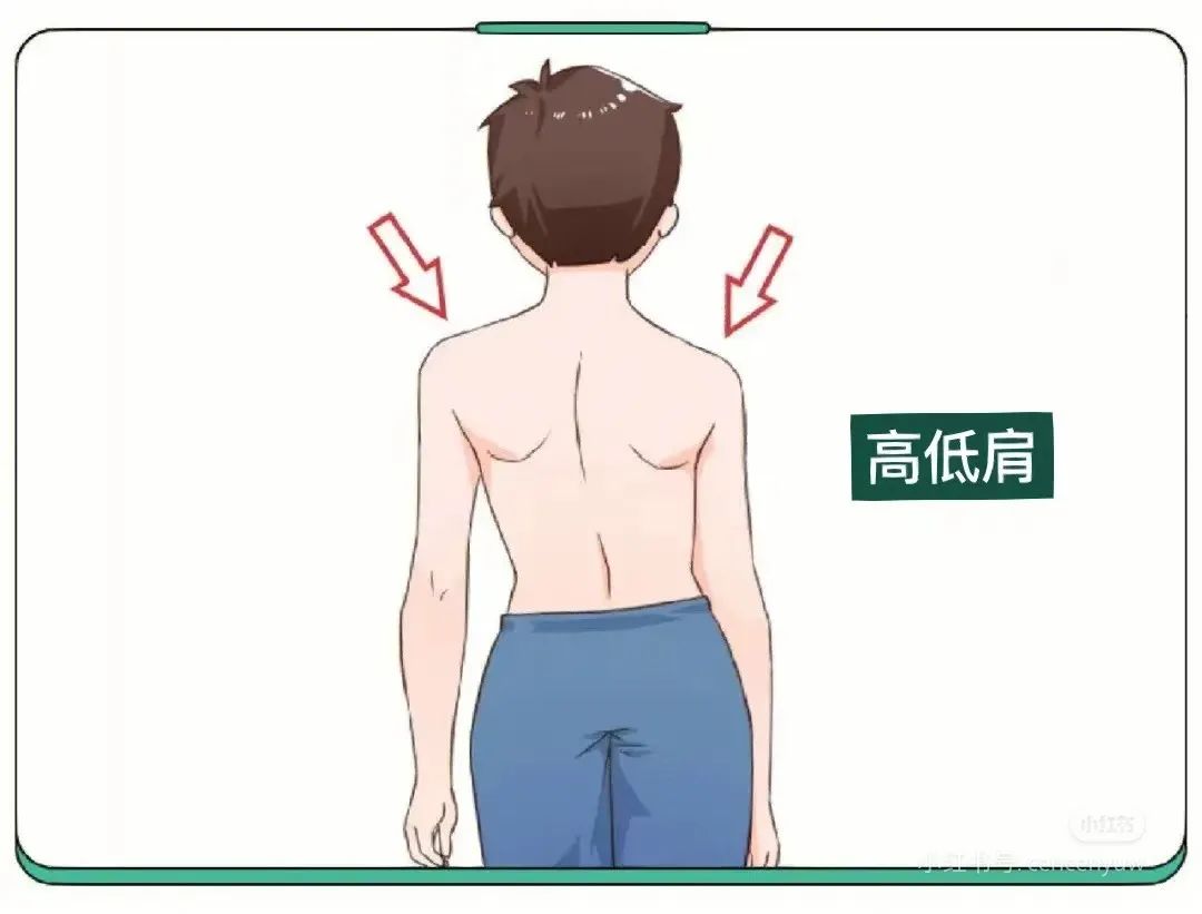 你的脊柱悄悄弯成「贪吃蛇」?速测气质杀手「S 弯超标没」!