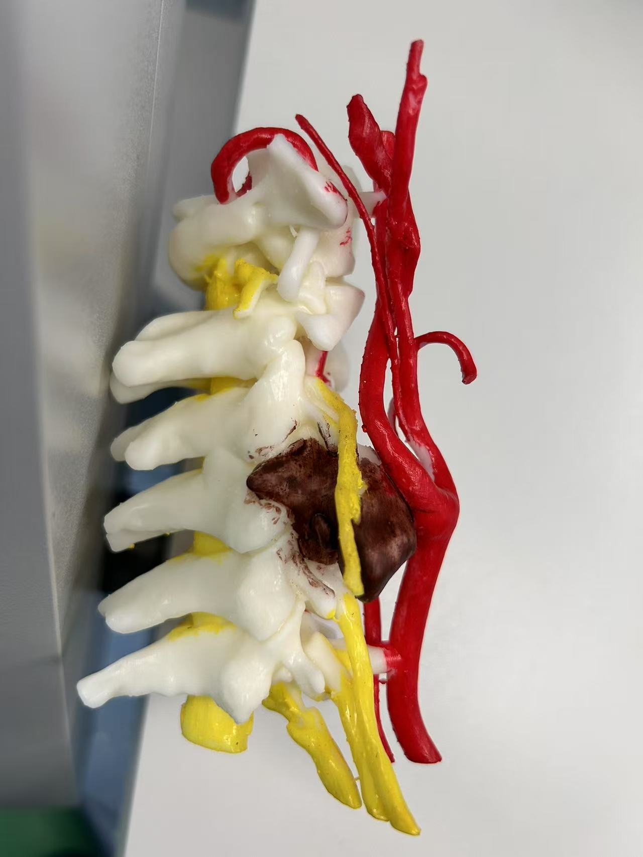 神经鞘瘤「缠绕」颈椎内重要动脉和神经 多学科专家 8 小时接力「拆弹」