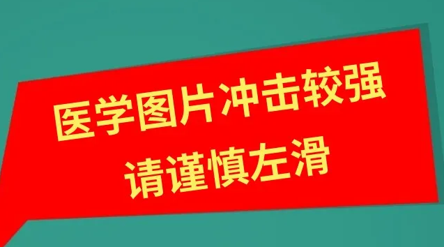3 岁娃患「儿童癌王」，15 cm 肿瘤长满腹腔！成妇儿「三明治疗法」帮他摘除