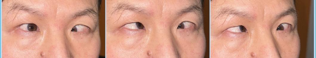 男子 40 岁黑眼珠开始跑偏，戴鸿斌院长动 6 条肌肉「改邪归正」