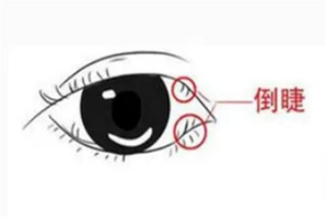 睫毛「倒戈」扎眼球？当心「眼中钉」毁视力！