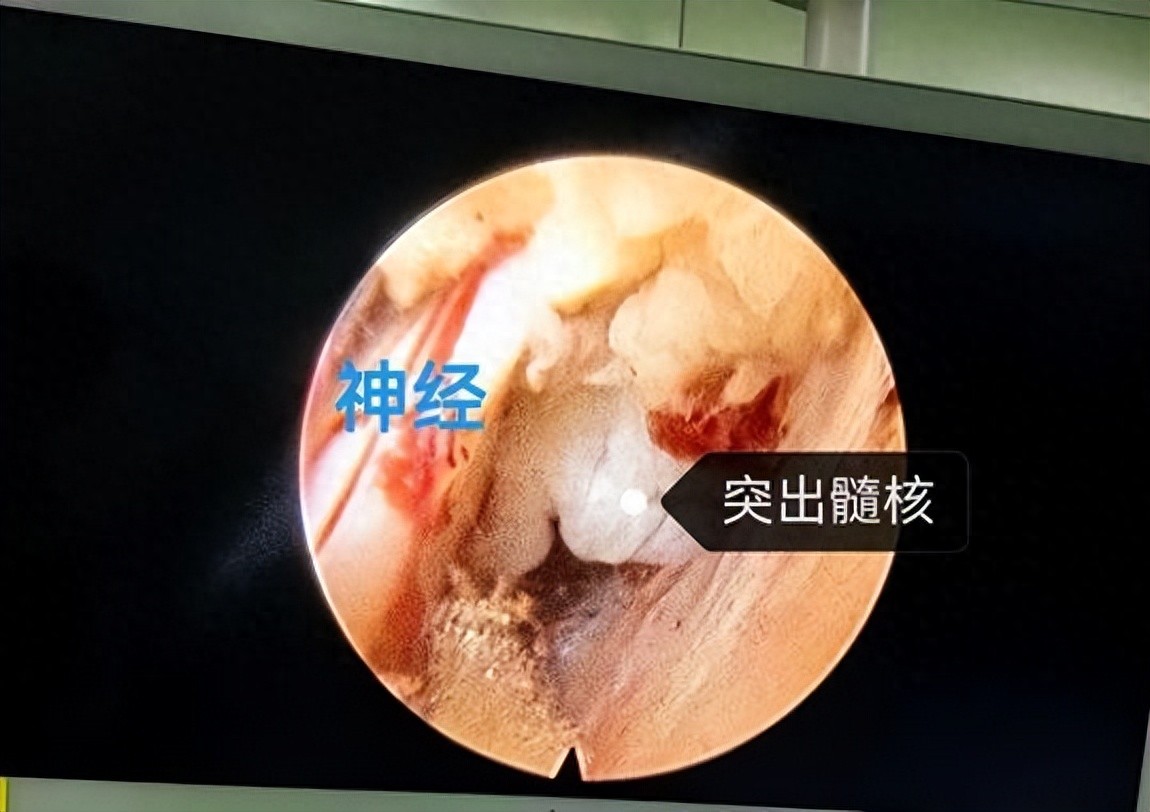武汉大学人民医院疼痛专家「毫米级」技术精准解除腰椎间盘突出剧痛