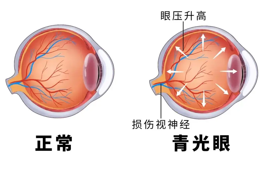 青光眼治疗后眼压正常了还需要复查吗？武汉普瑞眼科程旭康来科普