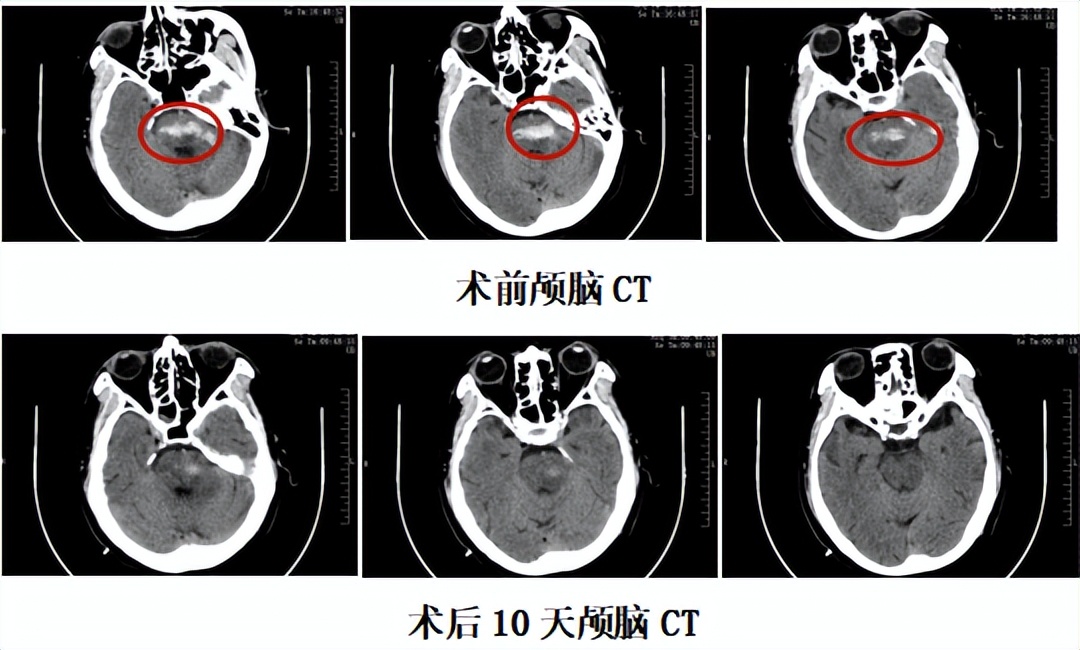 重症脑干出血患者危在旦夕 机器人立体定向手术抢救生命