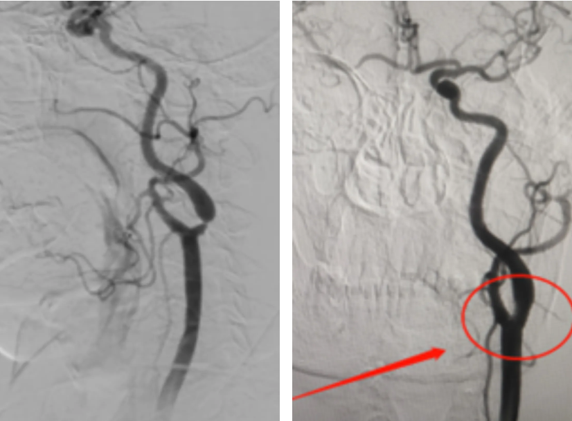 中风背后的「隐形杀手」 | 颈动脉狭窄在悄悄侵袭你的大脑