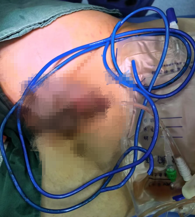 13 岁少年尿道塞入 2 米跳绳 医生呼吁:应重视青春期健康教育