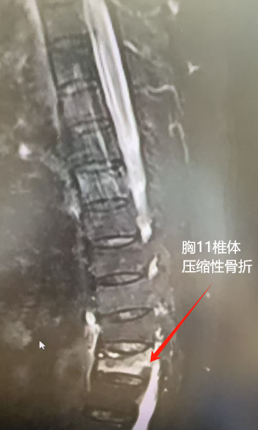 九旬老太胸椎骨折情况危急!启动绿色通道,抢跑「黄金 24 小时」