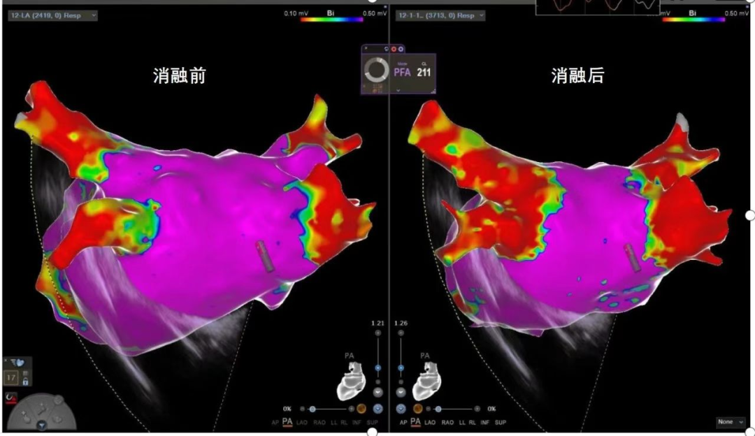西北首例 | 西安医学院一附院完成「零射线心腔内超声（ICE）联合三维标测系统指引脉冲场消融房颤」手术
