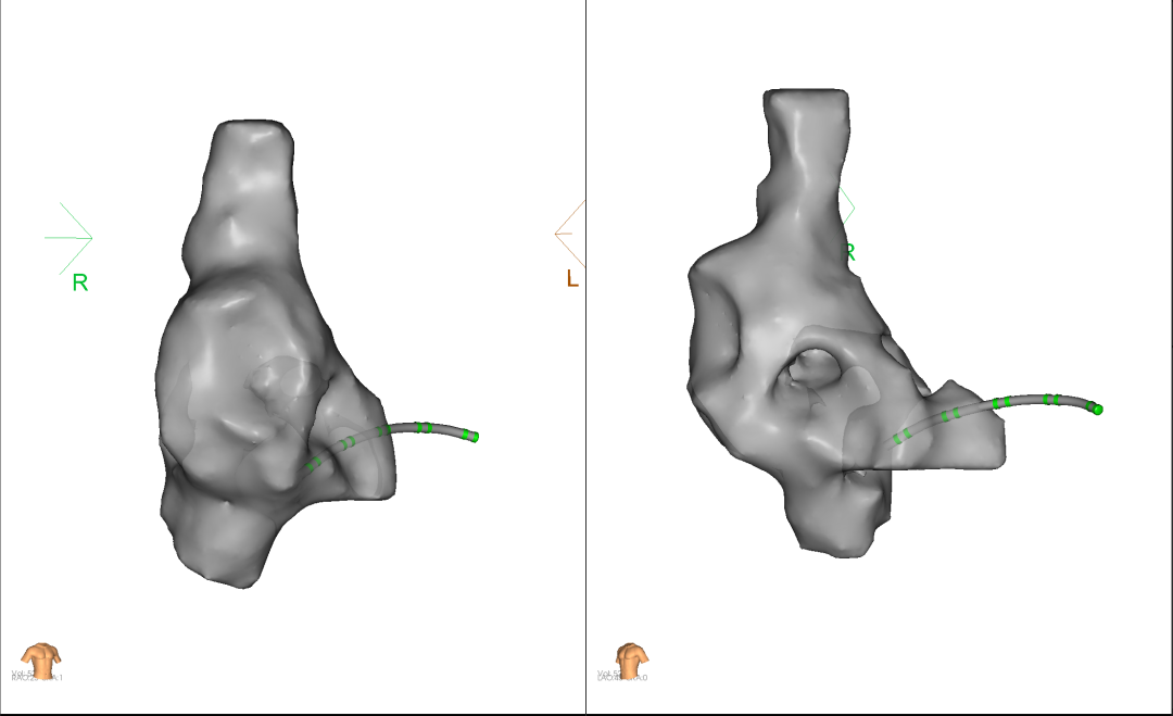 西北首例 | 西安医学院一附院完成「零射线心腔内超声（ICE）联合三维标测系统指引脉冲场消融房颤」手术