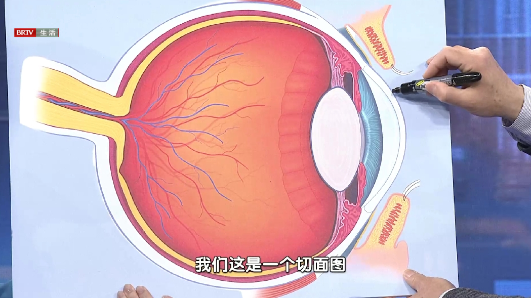 BRTV 全民健康学院:飞秒精雕定制矫正近视,开启精准摘镜新时代