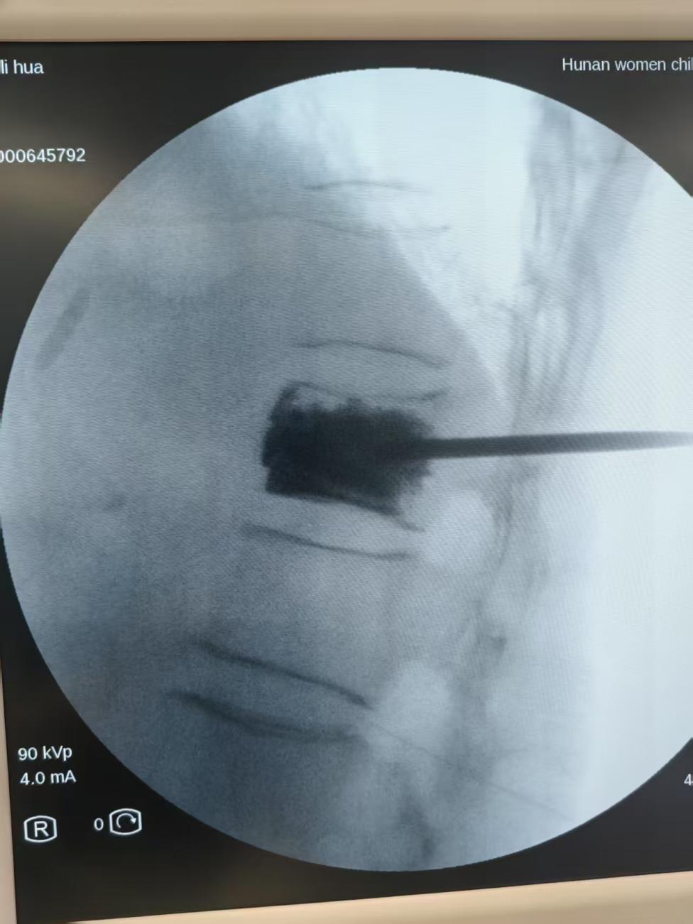九旬老太胸椎骨折情况危急!启动绿色通道,抢跑「黄金 24 小时」
