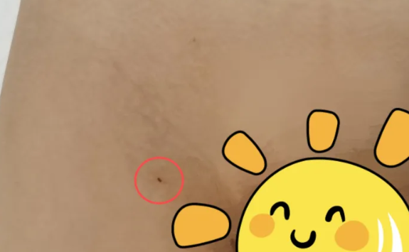 惊险！7 岁男童骑行摔伤致肝脾挫伤，江西省儿童医院微创介入手术化险为夷