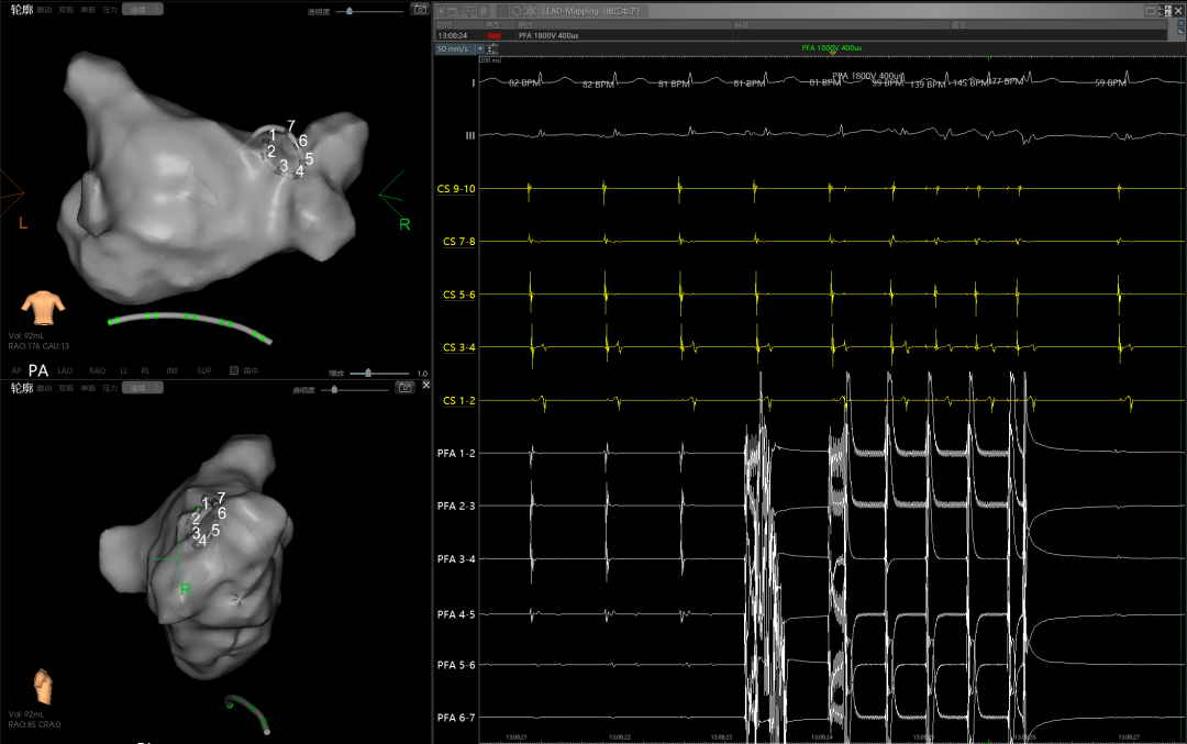 西北首例 | 西安医学院一附院完成「零射线心腔内超声（ICE）联合三维标测系统指引脉冲场消融房颤」手术