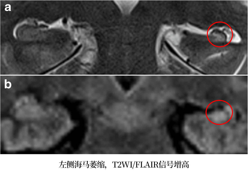 认识大脑的「记忆指挥官」——海马体