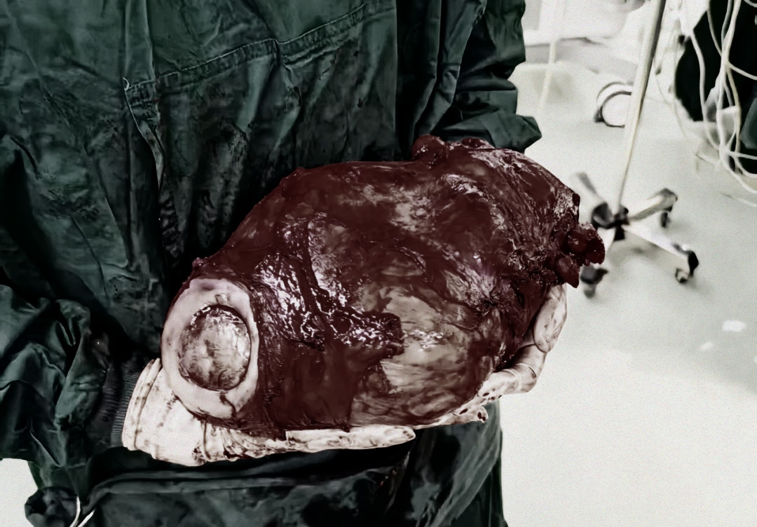 「瘤」影重重！本溪市中心医院成功为多手术史患者切除 3.5 公斤宫颈肌瘤