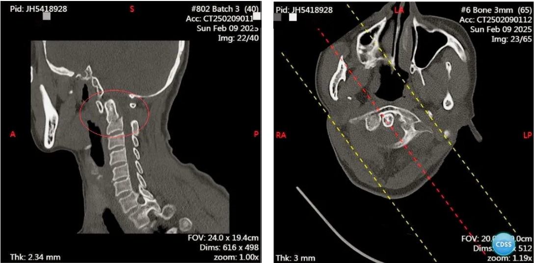 南京江北医院骨科成功开展首例「枢椎齿状突骨折前路复位空心螺钉内固定术」
