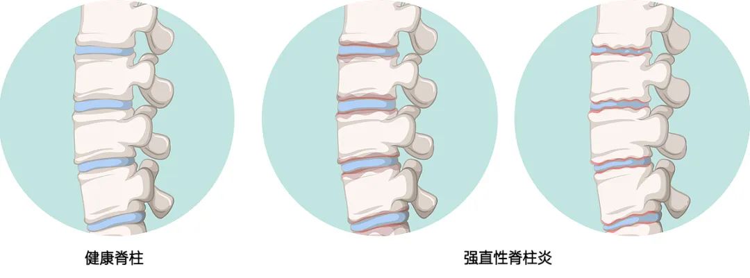合肥京东方医院科普：年轻人高发，可致残！很多人以为是普通腰痛