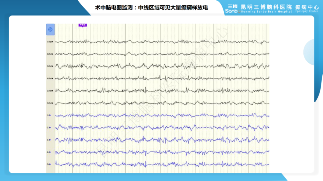 《「痫停」信步》癫痫治疗病例荟萃第四期---手术治疗脑膜血管瘤病致难治性癫痫