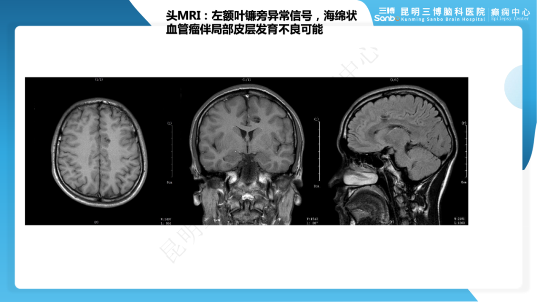 《「痫停」信步》癫痫治疗病例荟萃第四期---手术治疗脑膜血管瘤病致难治性癫痫
