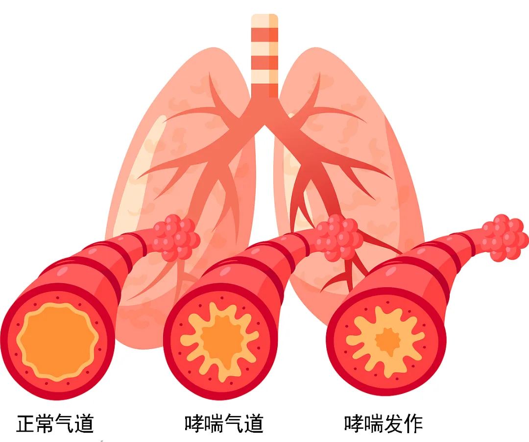 合肥京东方医院:只咳不喘、不咳不喘,竟然都是哮喘?很多人都忽视了……