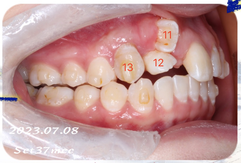 埋伏 20 年，她用 5 年时间让 3 颗大门牙「重见天日」