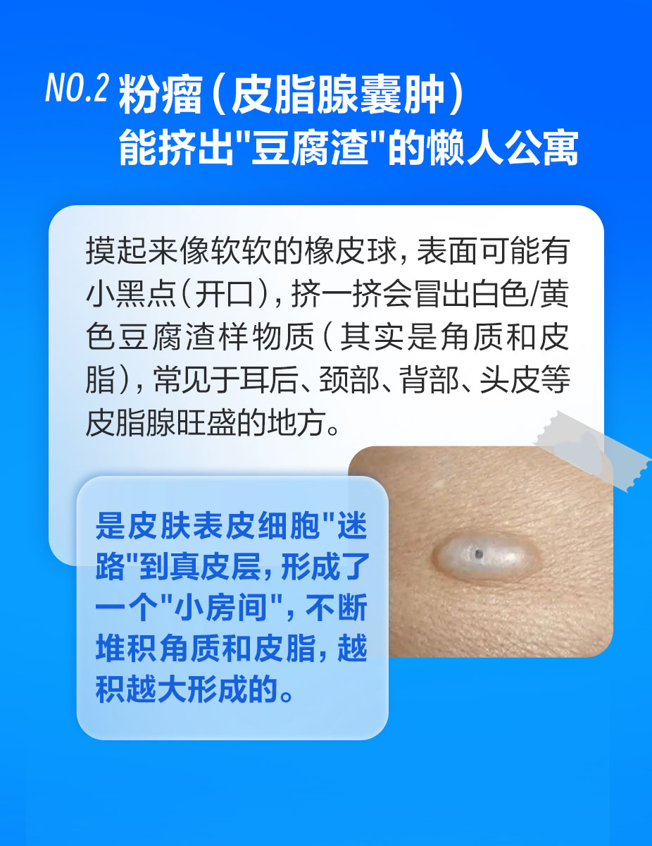 这些皮肤包千万别挤！当心越弄越糟