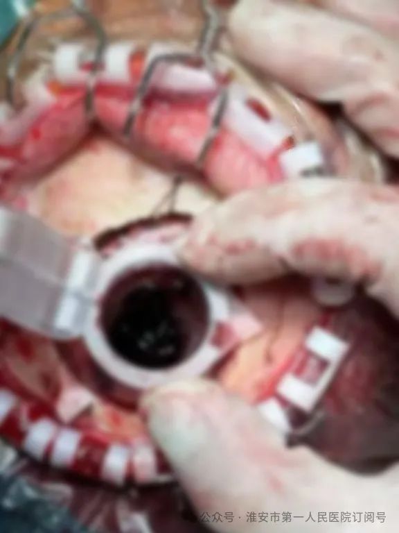 【疆陕共健】淮安市一院神经内镜技术落地边疆，脑出血患者无需千里求医