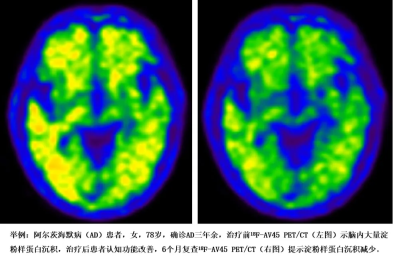 重大突破|新型 PET/CT 技术为阿尔茨海默病精准诊疗带来新希望