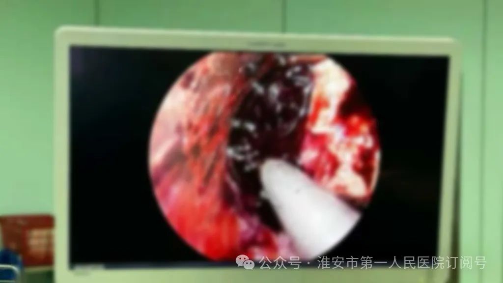 【疆陕共健】淮安市一院神经内镜技术落地边疆，脑出血患者无需千里求医