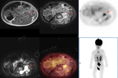 PET/MRI：见证神经母细胞瘤 2 岁患儿生命逆袭的诊疗轨迹