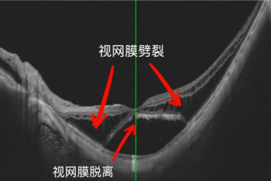 高度近视+视网膜脱离+视网膜劈裂，医生「打补丁」挽救视力