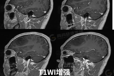 【高尚病例】低级别胶质瘤 1 例
