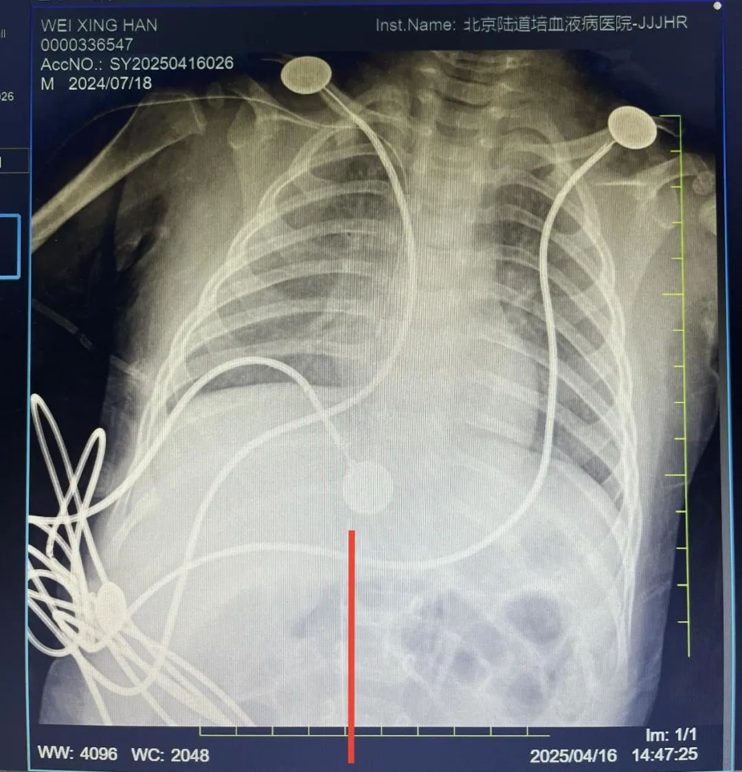 下肢股静脉 PICC 置管首战告捷！北京陆道培血液病医院实现「生命线」零误差精准定位