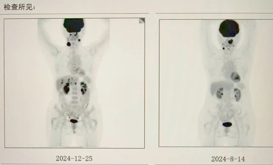 一例 TP53 突变高危 DLBCL 患者通过 CAR-T 及综合治疗成功逆转病情