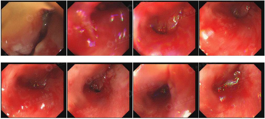 镜影联合|是什么原因让诊疗经验超 5 万例的主任医师中断检查？