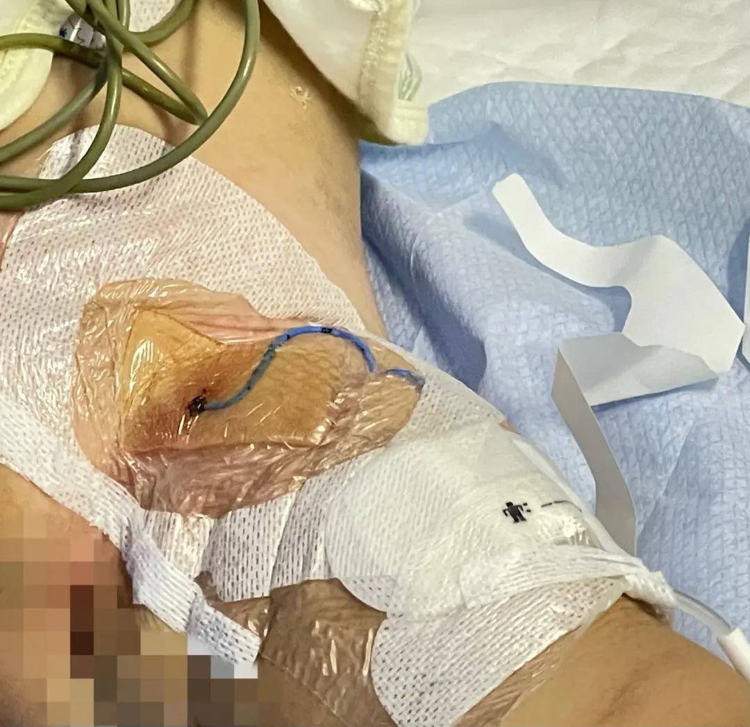 下肢股静脉 PICC 置管首战告捷！北京陆道培血液病医院实现「生命线」零误差精准定位