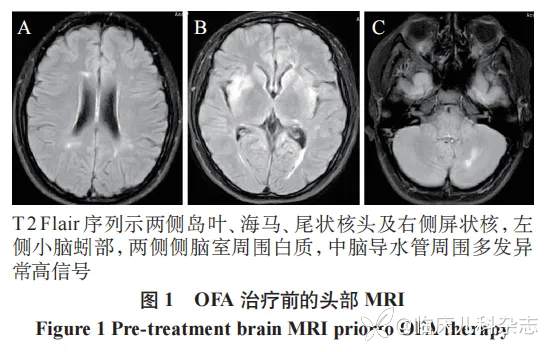 1 例青少年难治性视神经脊髓炎谱系疾病的诊治